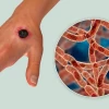 Emergency measures launched to curb anthrax outbreak; vaccination drive intensified