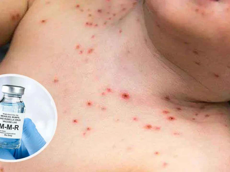 বাংলাদেশে বিশের অধিক জেলায় হামের প্রকোপ, জরুরি পদক্ষেপ সরকারের