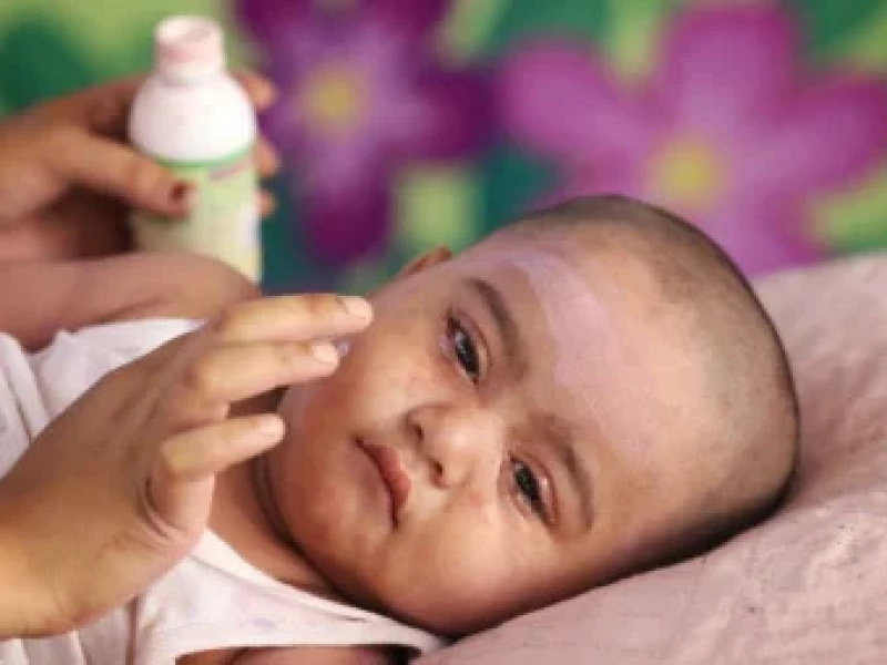 Govt says measles outbreak under control as 179 children die so far