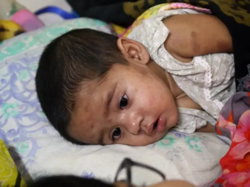 10 die of measles, similar symptoms in 24 hours: DGHS