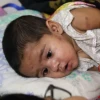 10 die of measles, similar symptoms in 24 hours: DGHS